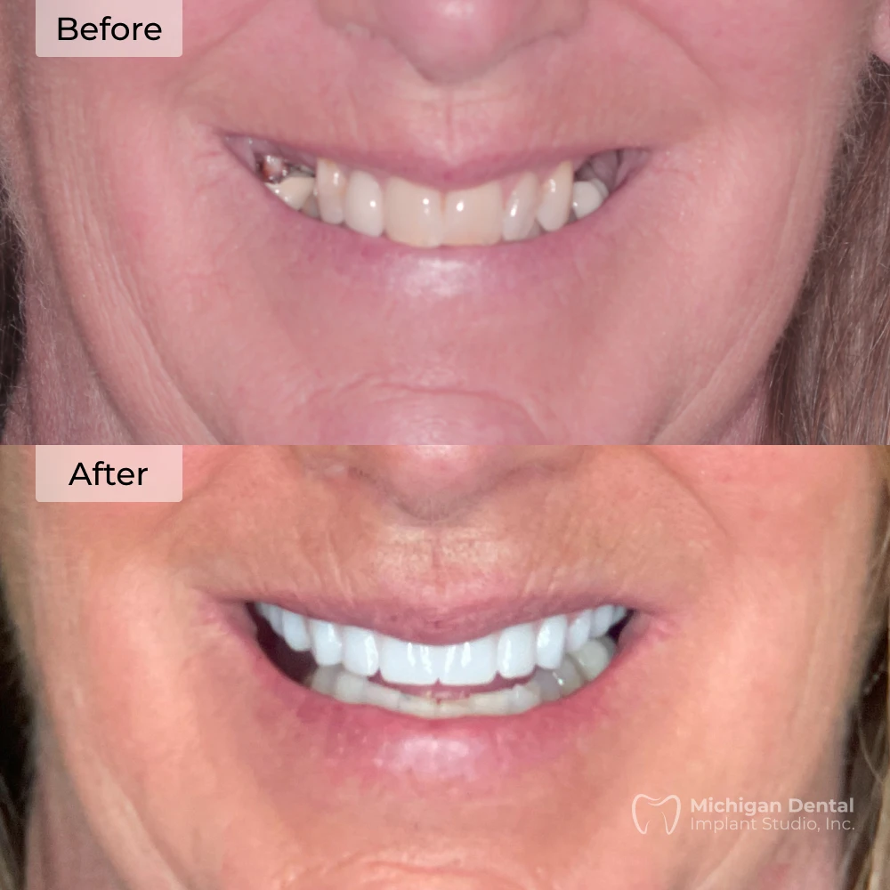 before and after dental implants