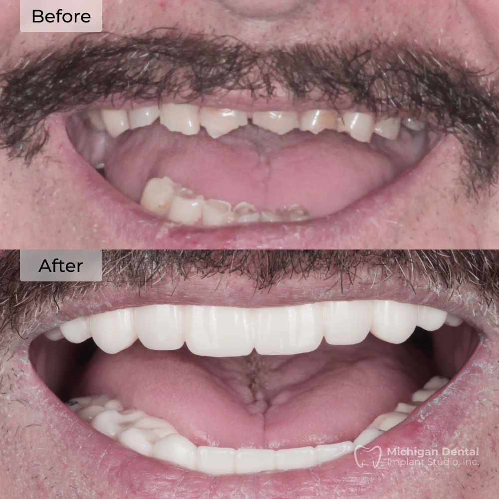 before and after dental implants