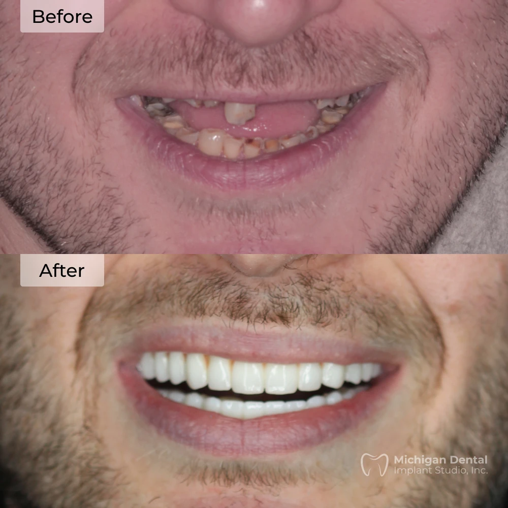 before and after dental implants