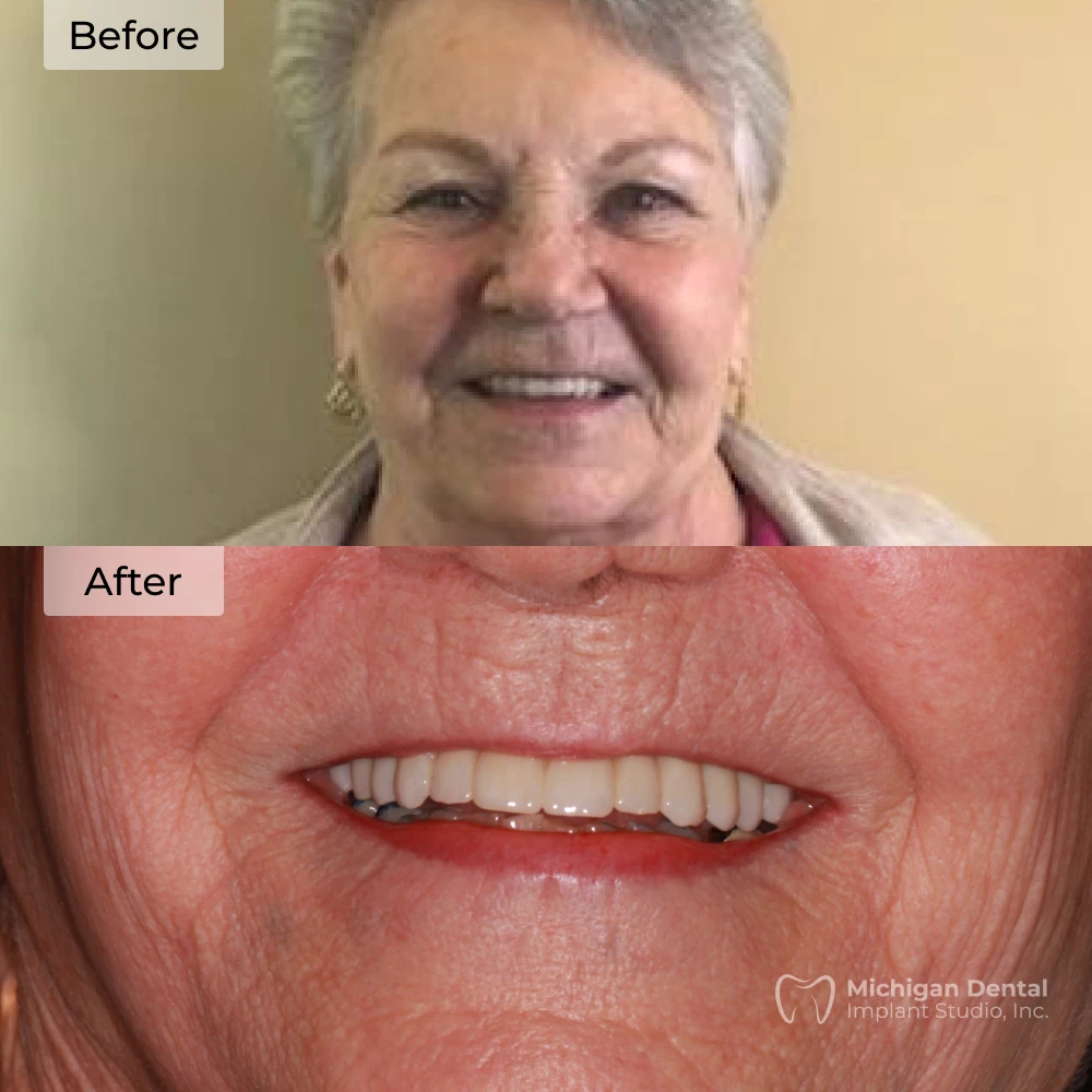 before and after dental implants