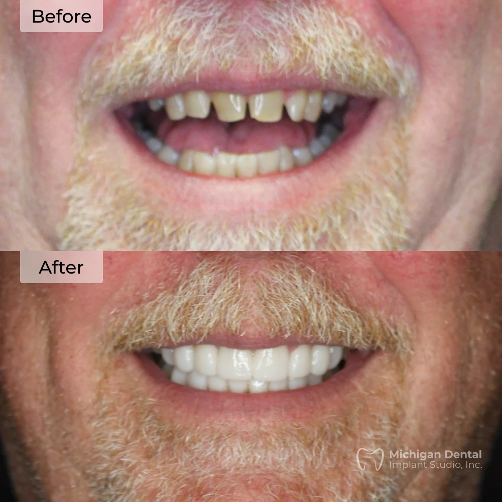 before and after dental implants