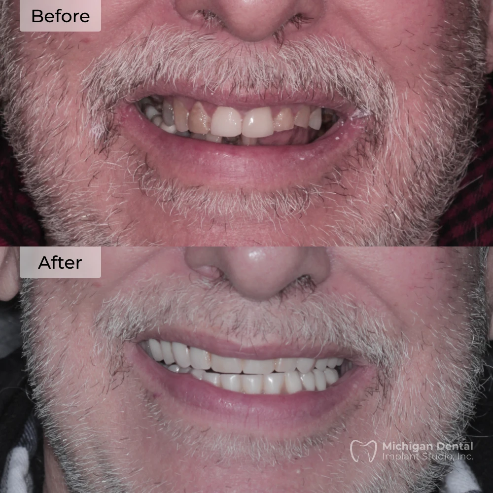 before and after dental implants
