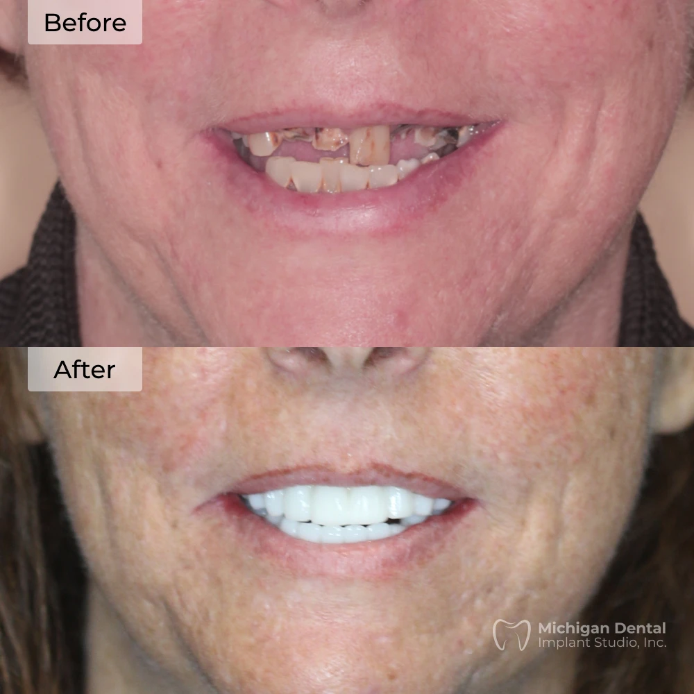 before and after dental implants