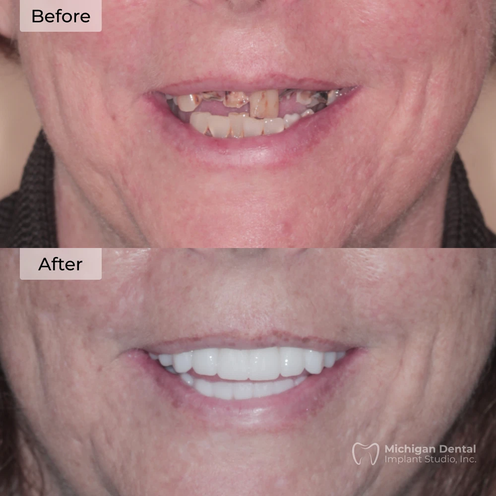 before and after dental implants