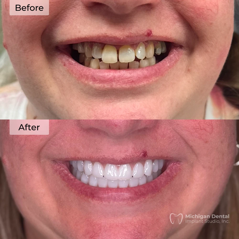 before and after dental implants in Michigan at Michigan Dental Implant Studio