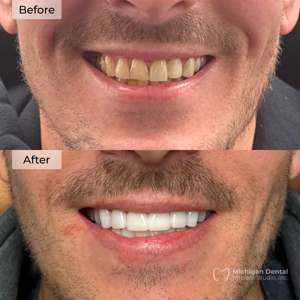 before and after dental implants in Michigan at Michigan Dental Implant Studio