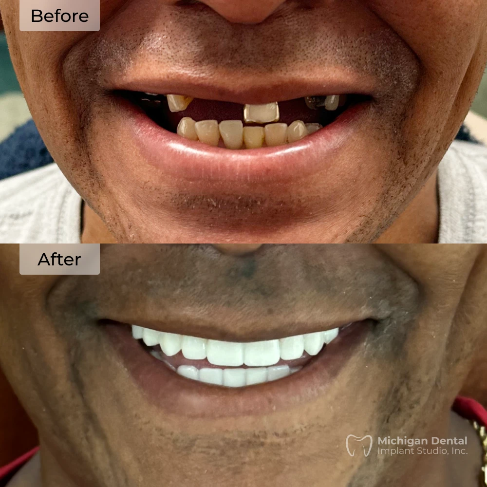 before and after dental implants in Michigan at Michigan Dental Implant Studio